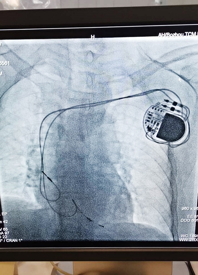 新的律动我院顺利开展院内首例永久性心脏起搏器植入术