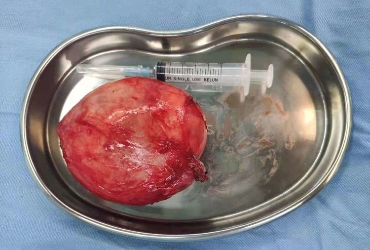 病例分享一例巨大甲状腺肿瘤的诊治